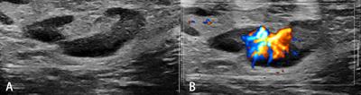 Ultrasound Elastography for the Evaluation of Lymph Nodes